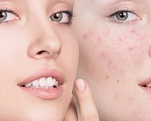 Acne Seborroica - immagine 1