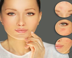 Acne Seborroica - immagine 3