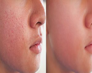 Acne Seborroica - immagine 2